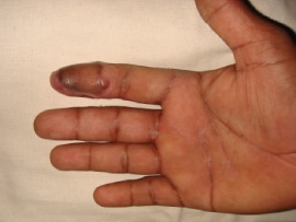 fingertip treatment in hyderabad