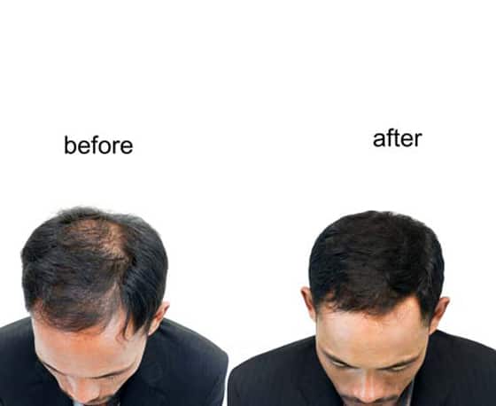 low cost without any side effects hair transplant treatment in hyderabad