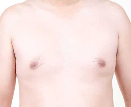 gynaecomastia surgery low cost clinic in india