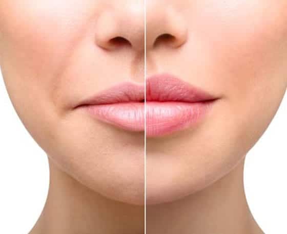 low cost best fillers treatment in hyderabad