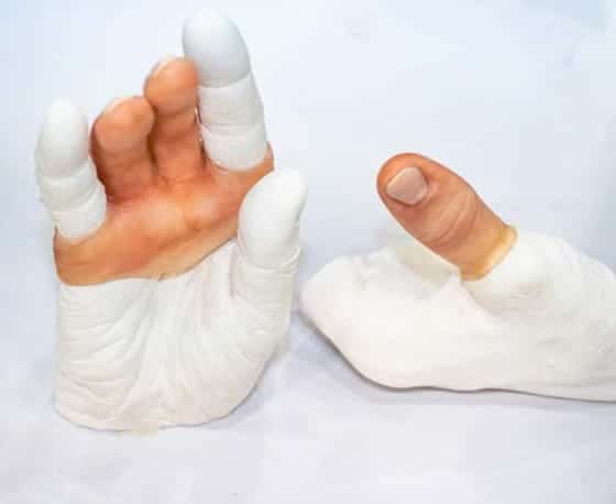 Best finger reconstruction treatment in hyderabad