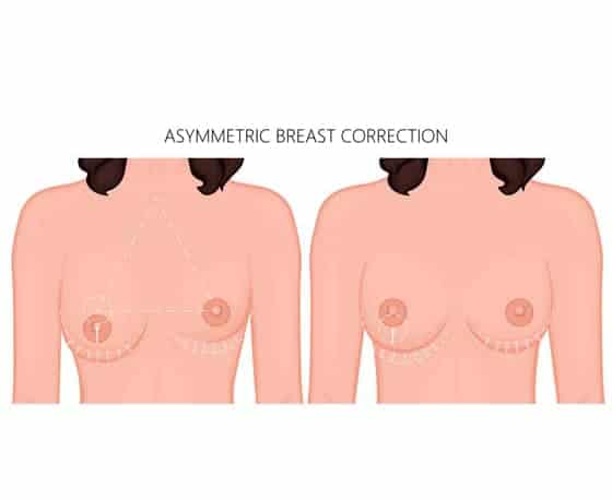 breast reconstruction surgery affordable price