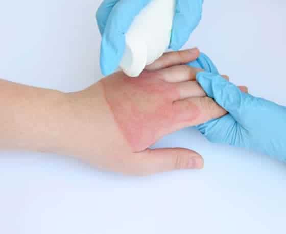 management of severe burns clinic