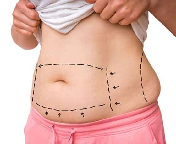 abdominoplasty treatment and tummy tuck surgery in hyderabad