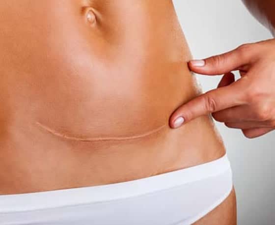 best scar removal treatments