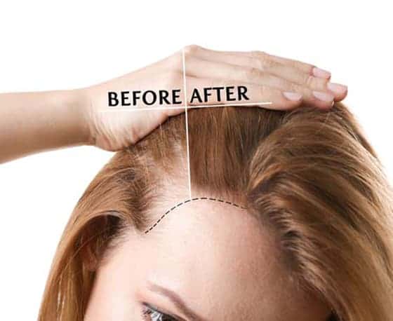 Best Hair Transplant Treatment Clinic In Hyderabad