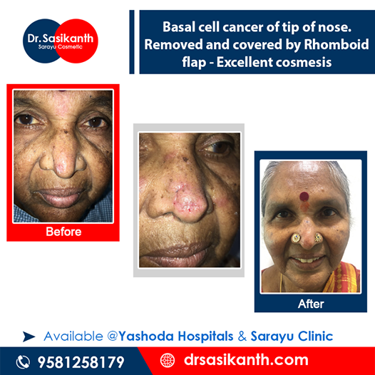 Basal call cancer of tip of nose