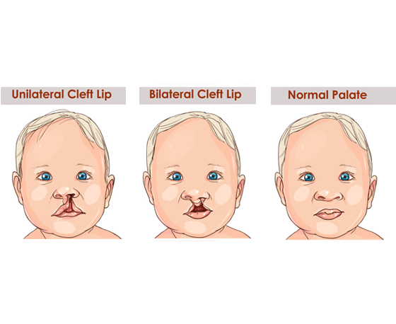 Cleft-lip-and-palate-surgery-in-Hyderabad