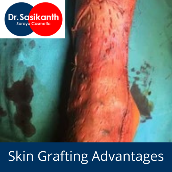 skin grafting advantages