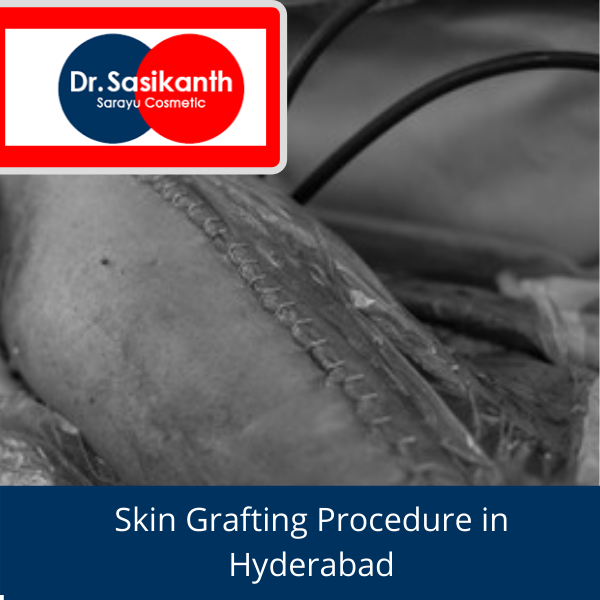 Skin Grafting Procedure in Hyderabad